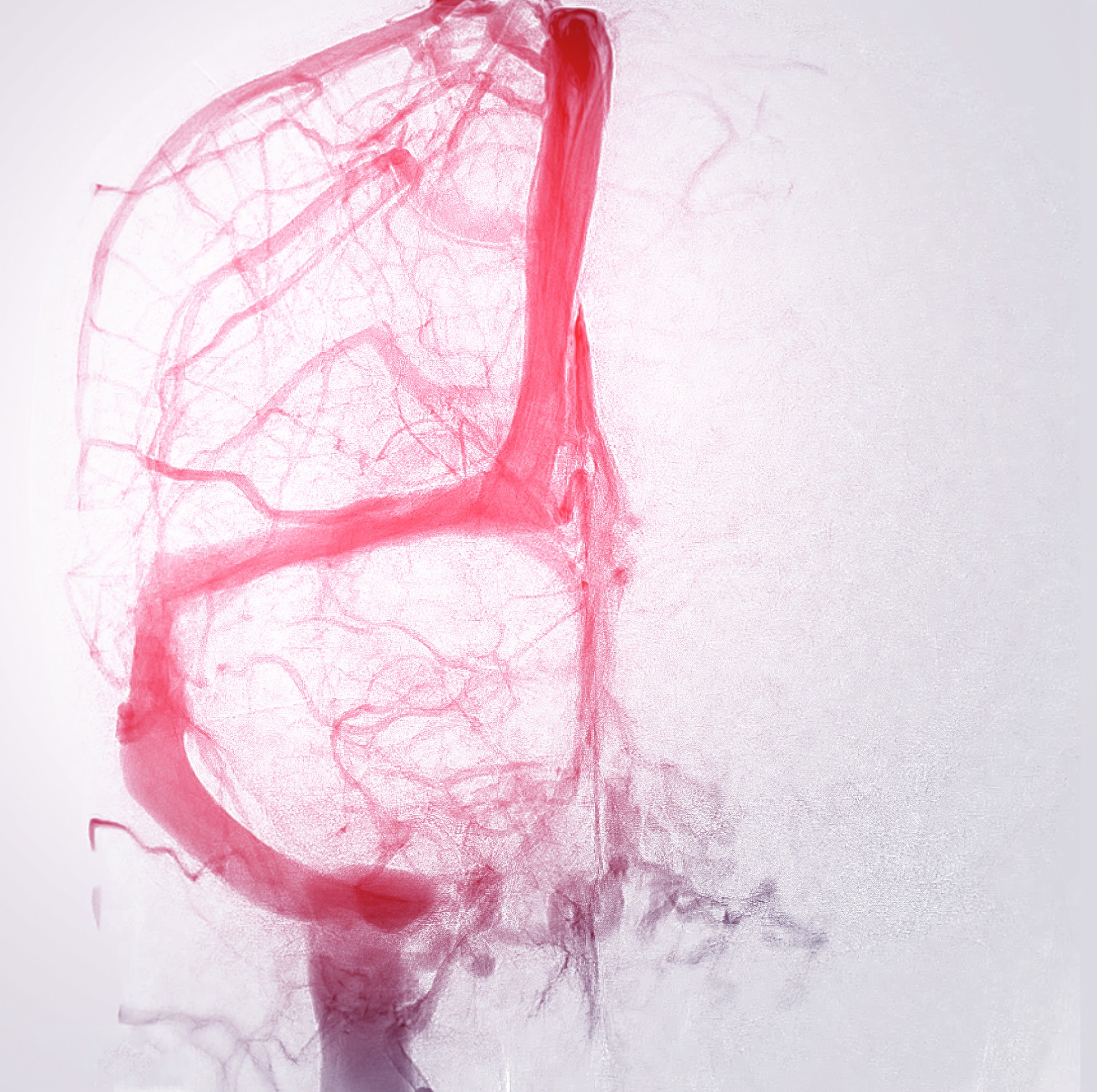 Cerebral angiography  image from Fluoroscopy in intervention radiology  showing cerebral artery.